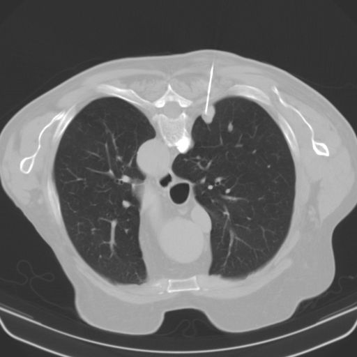 Abbildung 5 Beispiele für eine CT-gesteuerte Punktion einer Raumforderung in der Lunge bei V. a. ein BC (eigenes Patientenkollektiv) 3.2.