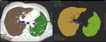 (1) Lung-PreProcessing Semi- oder voll-automatische Vorverarbeitung von Thorax-CT-Daten: Bronchialbaum-Segmentierung ggf.