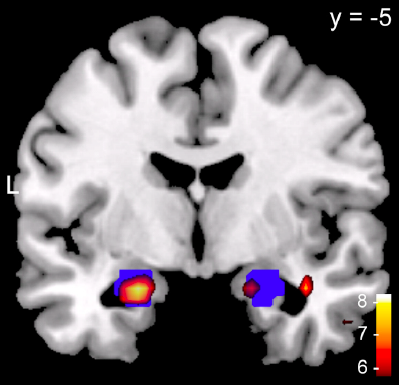 Neurowissenschaftliche Emotionstheorien Wichtigkeit der Amygdala für Emotionen eindrucksvoll belegt Neurotransmitter Noradrenalin entscheidend Amygdala entscheidend für emotionale Gedächtnisbildung