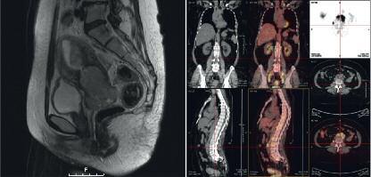 Abbildung 1: a) sagittale MRI-Darstellung eines Zervixkarzinoms mit erhaltender Fettlamelle zwischen Blase und Zervix uteri sowie zum Rektum; b) PET-CT-Darstellung einer Zervixkarzinom-Patientin mit