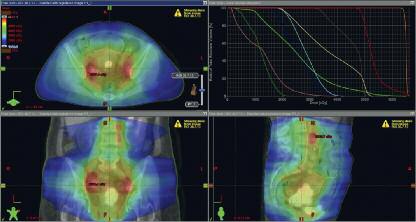 Abbildung 2: Zervixkarzinom FIGO IIIB, G3 mit pelvinen und paraaortalen Lymphknotenmetastasen: Bestrahlungsplanungs-CT verknüpft mit Staging-PET-CT zur Bestrahlungs-Dosiseskalation im Bereich der