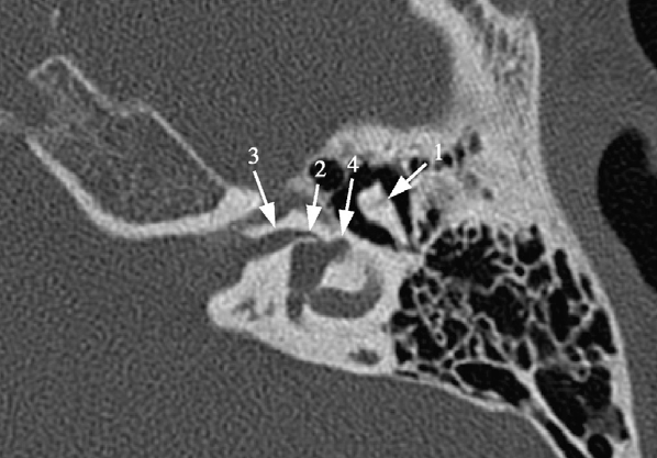 7.2. Abbildungen Abbildung : Abb. : Axiales MSCT-Bild eines normalen Felsenbeins. Das Trommelfell () verläuft lateral zur Chorda tympani (2).