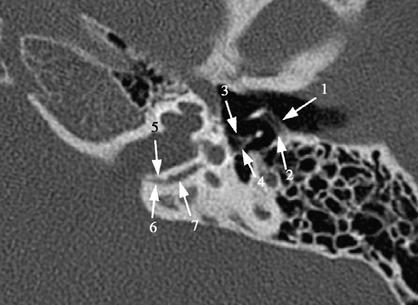 Abbildung 3: Abb. 3: Aus axialen MSCT-Bildern koronar multiplanar rekonstruierte Aufnahmen eines normalen Felsenbeins. Die Articulatio incudostapedialis (Pfeil) wird gezeigt. Abbildung 4: Abb.