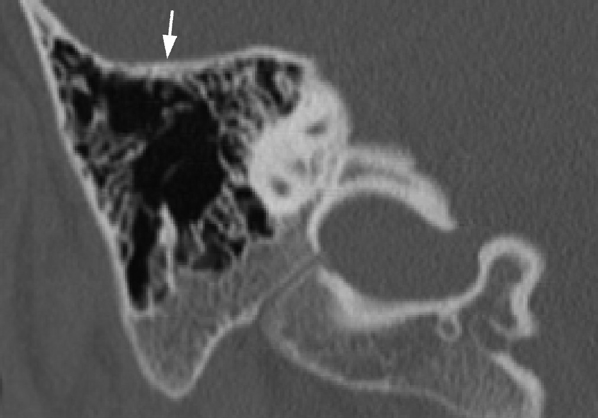 Abbildung 5: Abb. 5: Axiales MSCT-Bild eines normalen Felsenbeins. Eine normale articulatio incudomallearis () ist erkennbar. Der inferiore Anteil des N.