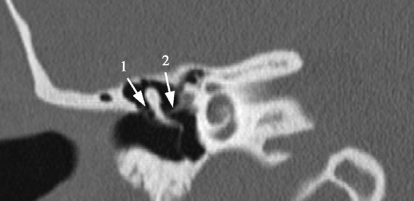Abbildung 9: Abb. 9: Axiales MSCT-Bild eines normalen Felsenbeins. Das Ligamentum mallei anterior (Pfeil) verläuft vom Processus anterior mallei zur petrotympanischen Fissur. Abbildung 0: Abb.