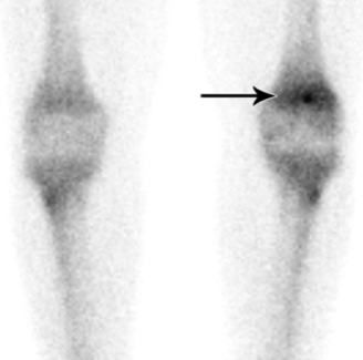 2. Einleitung 15 Nidus selbst nicht mehr gelingt (32, 39, 40) und zum anderen, dass das Osteoid-Osteom im Röntgenbild oftmals vergrößert erscheint (17).