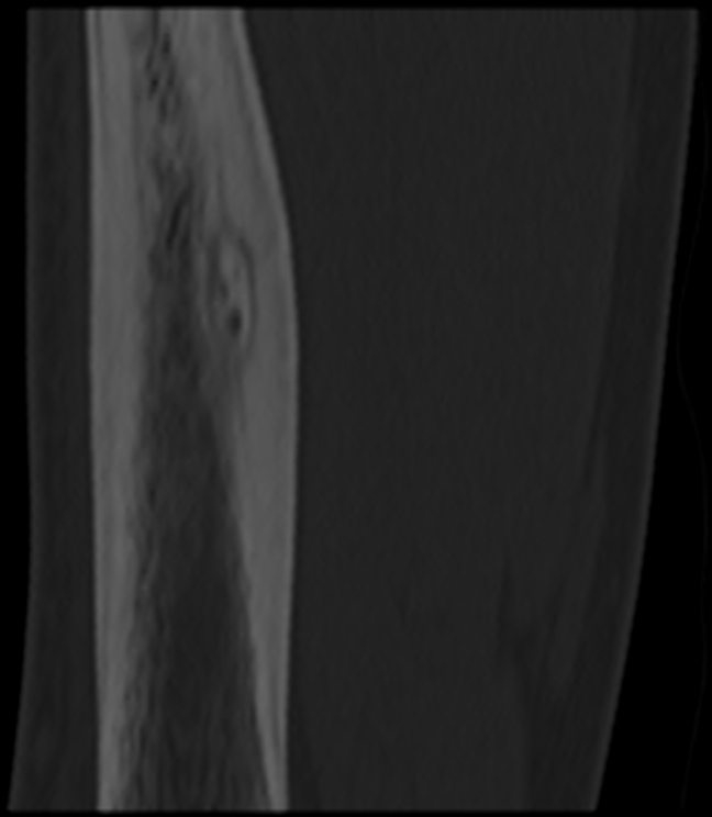 2. Einleitung 16 (a) (b) Abb. 9.: Typische computertomographische Darstellung eines kortikalen Osteoid-Osteoms des linken Femurs.