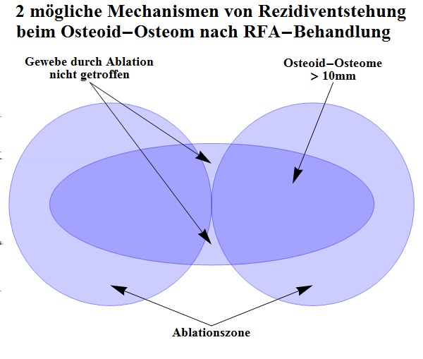 6. Diskussion 50 Abb. 36.: Darstellung eines möglichen Rezidivauftretens Auch Woertler et al.
