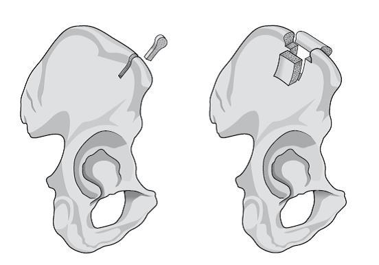 Krankheitsbilder, Operationen und Komplikationen Abbildung 2-9 Linkes Bild: kleinerer trikortikaler Span; Rechts: