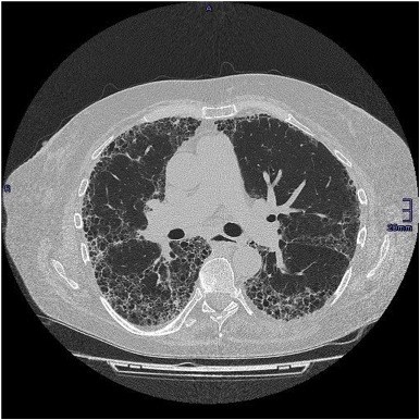 Fall 6 In der ergänzenden CT-Thorax Nachweis intestitieller, feinretikulärer