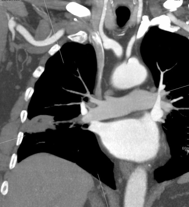 Fall 7 In der pulmonalen CTA KM-Abbruch in den Mittellappenarterien