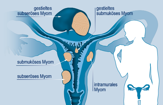 Was sind Uterusmyome? Je nach Lage werden submuköse (unter der Schleimhaut), intramurale (in der Gebärmutterwand) oder subseröse (unter der Gebärmutteroberfläche) gelegene Myome unterschieden (vgl.