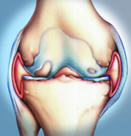 Das Synvisc - Programm für nachhaltiges Arthrosemanagement Es knackt und knirscht im Knie. Die Gelenke schmerzen und jede Bewegung wird zur Qual: Diagnose Arthrose.