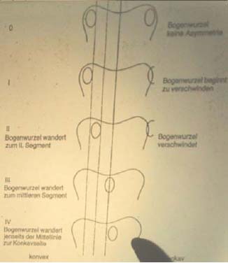 Untersuchung: Röntgen: Position der Bogenwurzel ist verdreht Wirbelsäule (Dornfortsätze) im Lot (Lot am 7.