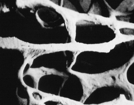 Was ist Osteoporose? Osteoporose, die auch die "stille Epidemie" genannt wird, ist ein Knochenschwund bzw. eine Knochenarmut an der Männer und Frauen leiden können (1 Mann für 3-4 Frauen).