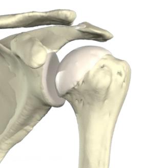 Anatomie Refresher: Knochen und Gelenke Schlüsselbein (Clavicula) Rabenschnabelfortsatz AC-Gelenk (Proc.