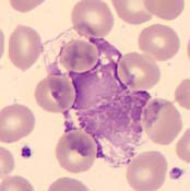 WBC: Zerstörte Zellen A) Zerstörte PMN = PolyMorphNukleäre = Neutrophile B) Zerstörte PMN mit erkennbaren Granula a) Zerstörte BASOPHILE: Werden gezählt als Basophile b) Zerstörte