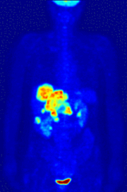 PET Ganzkörperaufnahme Maximum Intensity Projection (MIP) mit 18 F-FDG (Darstellung von Glukosetransport und -umsatz) Rot: Hohe Aufnahme von FDG