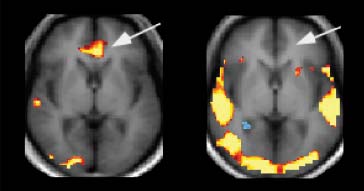 Veränderungen im menschlichen Gehirn - Positronen Emissions Tomographie Verminderung grauer Substanz