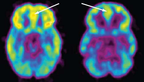 Veränderungen im menschlichen Gehirn - Positronen Emissions Tomographie Verminderung von D2 Rezeptoren im Striatum