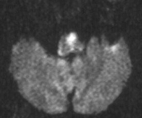 der linken A. vertebralis festgestellt werden. 0 Abbildungen 9a (links oben) und b (links unten), 0 (rechts): MRT von Patient mit Avellis-Syndrom.