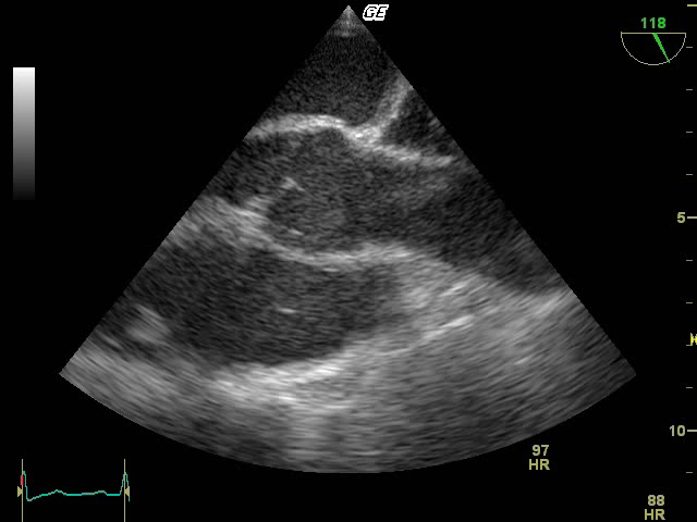 7. Mitt-ösophagealer Längsschnitt ( 90, 30 cm) Aortenklappe längs, ascendierende Aorta, LA, RVOT, Art. pulmonalis Beurteilung der Aortenklappe 8.