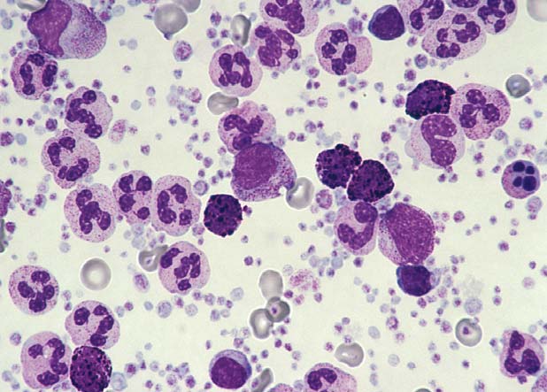 Chronisch Myeloische Leukämie Häufig Zufallsbefund im Blutbild