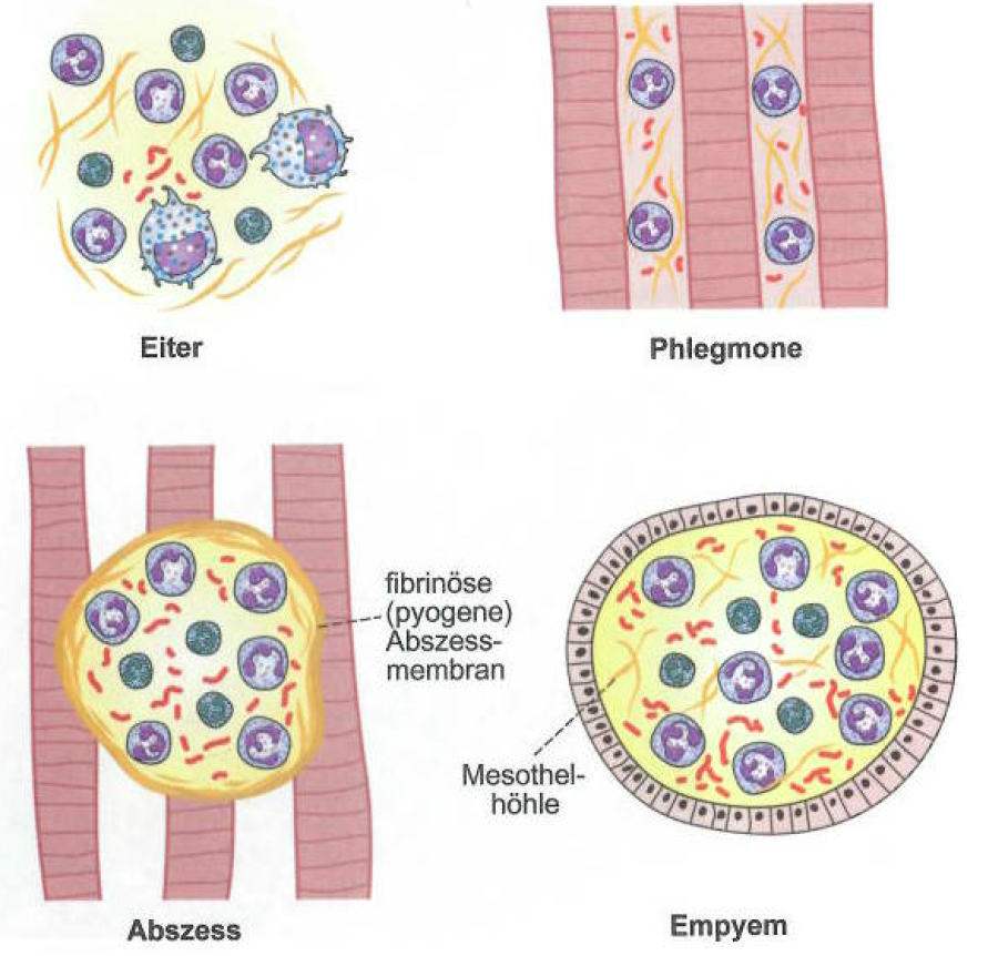 Lokalisierte Infektion Eitrige Entzündungsreaktion Fibrin