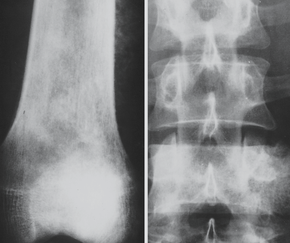 308 Kapitel 5 Knochentumoren sarkom abgegrenzt werden, bei älteren Patienten von Metastasen, Lymphomen und malignen fibrösen Histiozytomen.