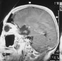 Landmarken erlauben und nicht wesentlich größer sein, als zur Entfernung des Tumors nötig ist.