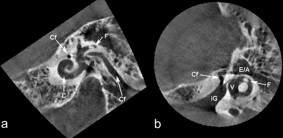 Abbildung 3.4.1 Dehiszenter Canalis semicircularis sup. (Pfeil) im Felsenbein O.