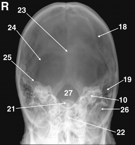 Schädel 291 25.2. Gehirnschädel (Neurocranium) Die das Schädeldach bildenden Knochen des Gehirnschädels bestehen aus platten Knochen.