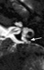 Schädel 315 Abb. 25.31 Mondini-Fehlbildung: Im CT (links; 2. v.l.) zystische Transformationen der Cochlea (Pfeil) und der Bogengänge. Abb. 25.32 Schwerhörigkeit: Pathologische Erweiterung des Ductus endolymphaticus (T2w, Pfeil 3.