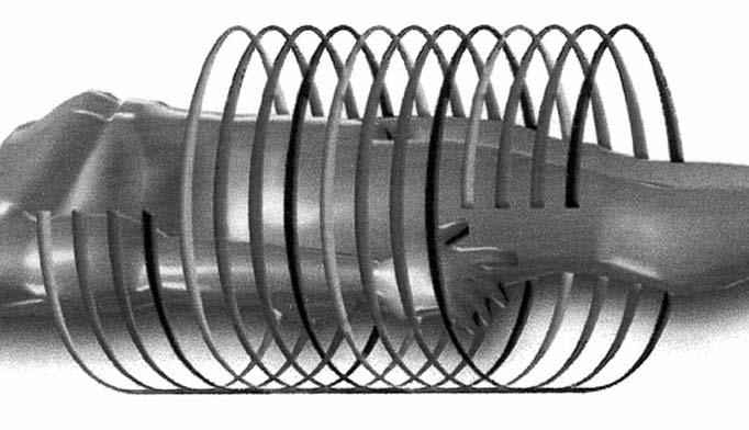 2.5.2 Mehrzeilen-Detektor-Spiral-Computertomographie (MDCT) Die Mehrzeilen-Detektor-Spiral-Computertomographie stellt die Weiterentwicklung der Spiral-Computertomographie dar.
