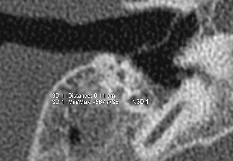 Abb. 35 Messung des Durchmessers des Canalis facialis im Bereich des Mastoids {3D 1} [CT_CFM_re] mit Tool 2D Distance Die dritte