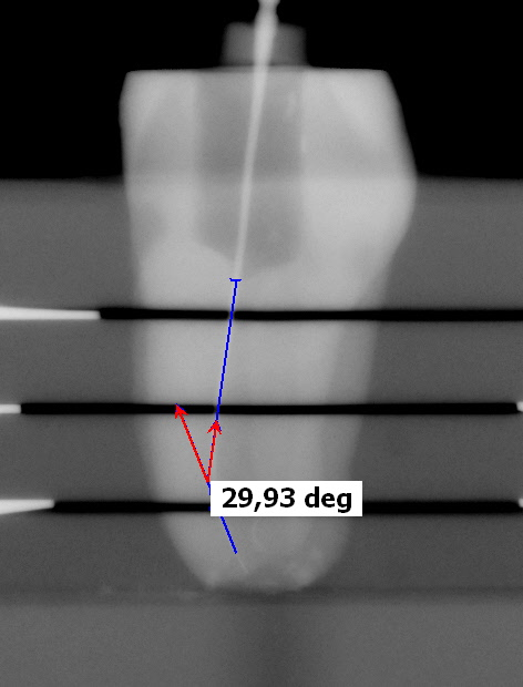 4 Material und Methoden 26 Mit Hilfe der ermittelten Krümmungswinkel fand eine Klassifizierung und Vorsortierung der Zähne in drei Gruppen statt: a) geringe Krümmung: < 25 b) mäßige Krümmung: 25 bis