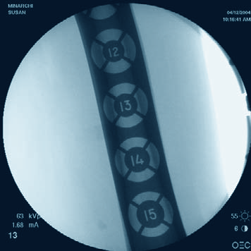 3 Nagellänge und Durchmesser bestätigen Instrument 03.010.021 Messlehre für Tibianagel, Länge 450 mm Nach der Reposition der Unterschenkelfraktur muss die er - forderliche Nagellänge bestimmt werden.