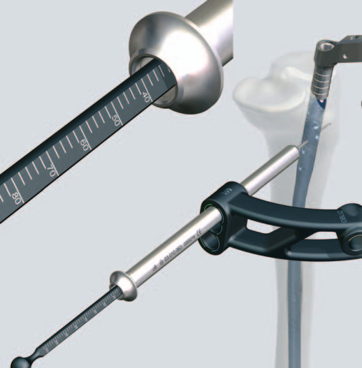 Proximal verriegeln Alternatives Instrument 03.010.072 Tiefenmessgerät für Verriegelungsschrauben Nach dem Durchbohren beider Kortikales den Spiralbohrer und die Bohrbüchse entfernen.