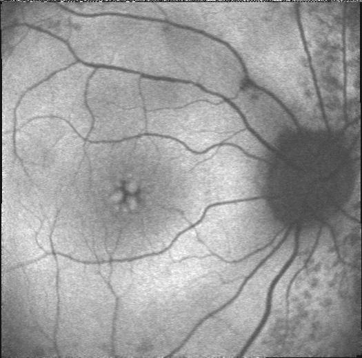 Abb. 3: 40-jährige Patientin (K025), rechtes Auge, Visus: 0,4, rotfreies Fundusbild (links) mit dazugehöriger FAF (rechts); zentral mehrere kleine Aufhellungen, sternförmig