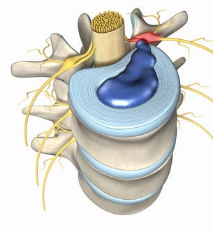 Typische SpineMED Indikationen Hernien/Bandscheibenverletzungen: Bandscheibenvorwölbung, Bandscheibenvorfall, Ischialgie (mit/ohne radikulärer