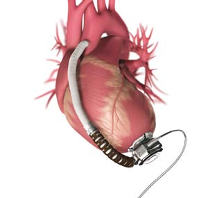 Das Leitsymptom der Herzinsuffizienz besteht in der Luftnot, zunächst bei Belastung und später auch in Ruhe. Im fortgeschrittenen Stadium lagert sich Wasser im Gewebe (Ödeme) z.b. in den Extremitäten ab.