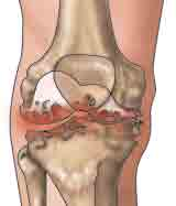 1 - Das Knie und die Gonarthrose (Kniegelenksarthrose) ANATOMIE DES KNIES gesundes Knie Das Kniegelenk besteht aus drei Knochen: Oberschenkelknochen (Femur), Schienbein (Tibia) und Kniescheibe