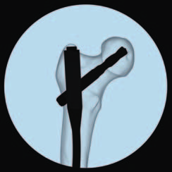 Anwendungsbereich Implantatextraktion einer PFNA/PFNA-II Klinge in bestimmten klinischen Fällen, wenn die Klinge beschädigt ist.
