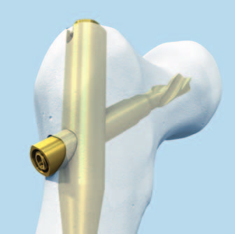 Beispiele für klinische Fälle von beschädigten Klingen Beschädigter Klingenantrieb Mögliche Lösungen Klinge mit der Zange entfernen (siehe Schritt 3 der Operationstechnik, Seite 15) Klinge mit dem