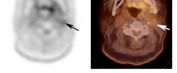 DWI-MRI beim HNSCC 58 Pat.