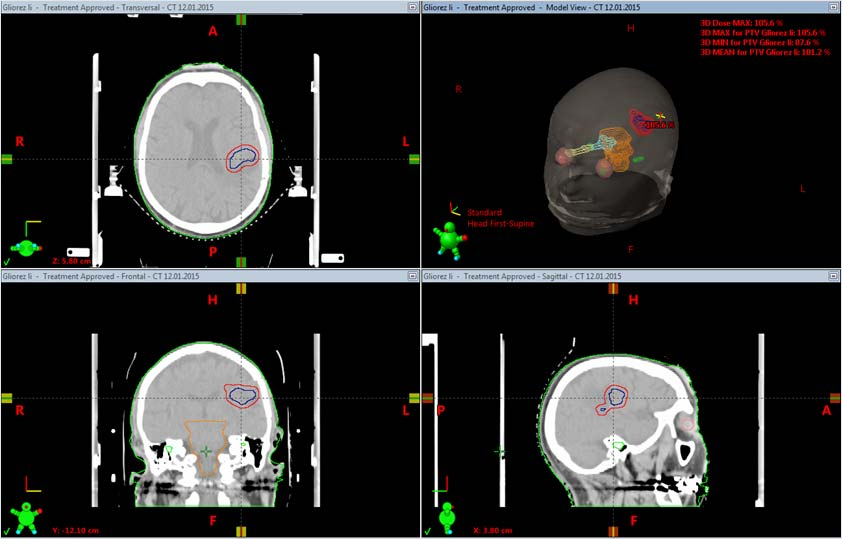Example: Recurrence of a Glioblastoma CT with GTV