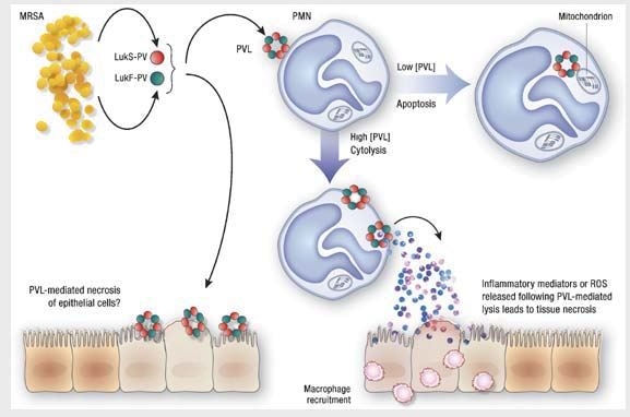 Panton-Valentine-Leukozidin Porenbildung in der Membran von Makrophagen: S aureus Lyse, Zytokinausschüttung und Leukopenie Gewebsnekrose,