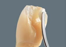 Individualisierung von VITA Kunststoffzähnen Die Zahnform wird mit ENAMEL, EFFECT ENAMEL oder NEUTRAL Massen ergänzt und polymerisiert. Polymerisationszeiten und -hinweise auf Seite 26-27 beachten!