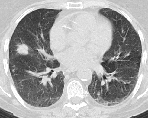 CT-gesteuerte Lungenbiopsie Histologie: Diffus
