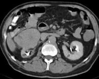Splitbolus-CT der Nieren Kontrastmittelphasen Niere 20